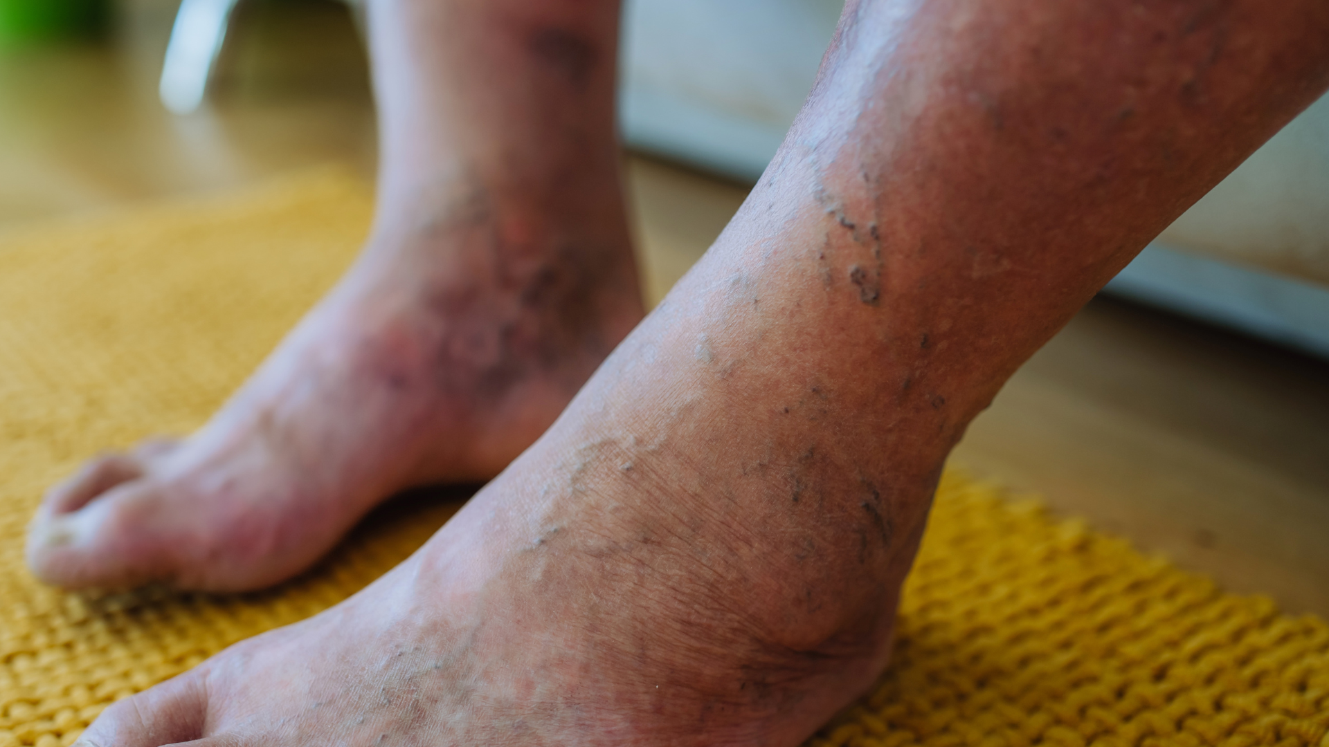 При какви медицински състояния е препоръчително носенето на чехли с ортопедична подметка? / Полезни статии / При какви медицински състояния е препоръчително носенето на чехли с ортопедична подметка? / Полезни статии /